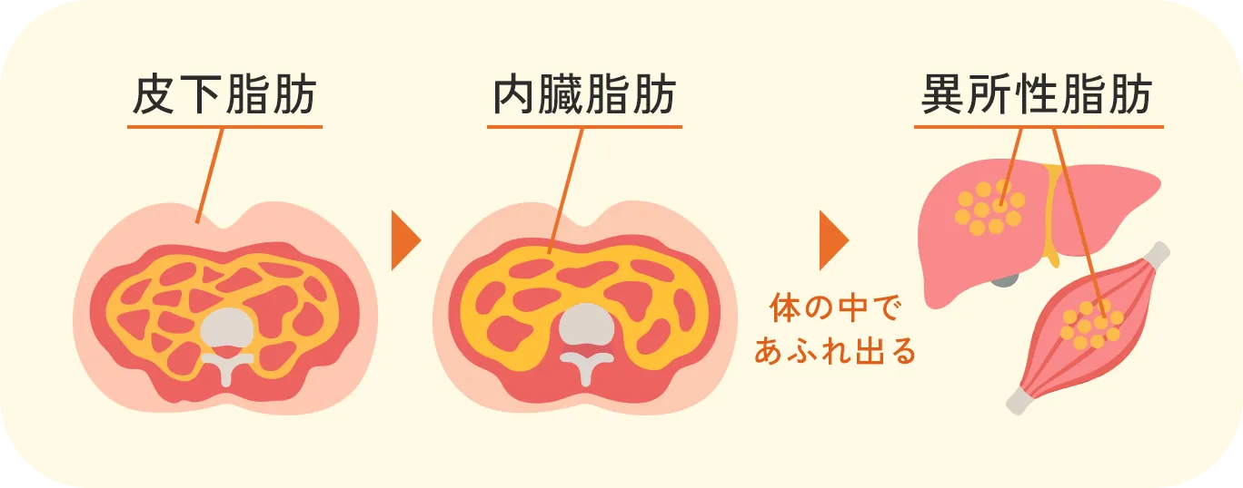 胴体を輪切りにしたイラスト：一番外側の皮下脂肪、内臓の周りにつく内臓脂肪、体の中であふれ出て筋肉や内臓の中にたまる異所性脂肪