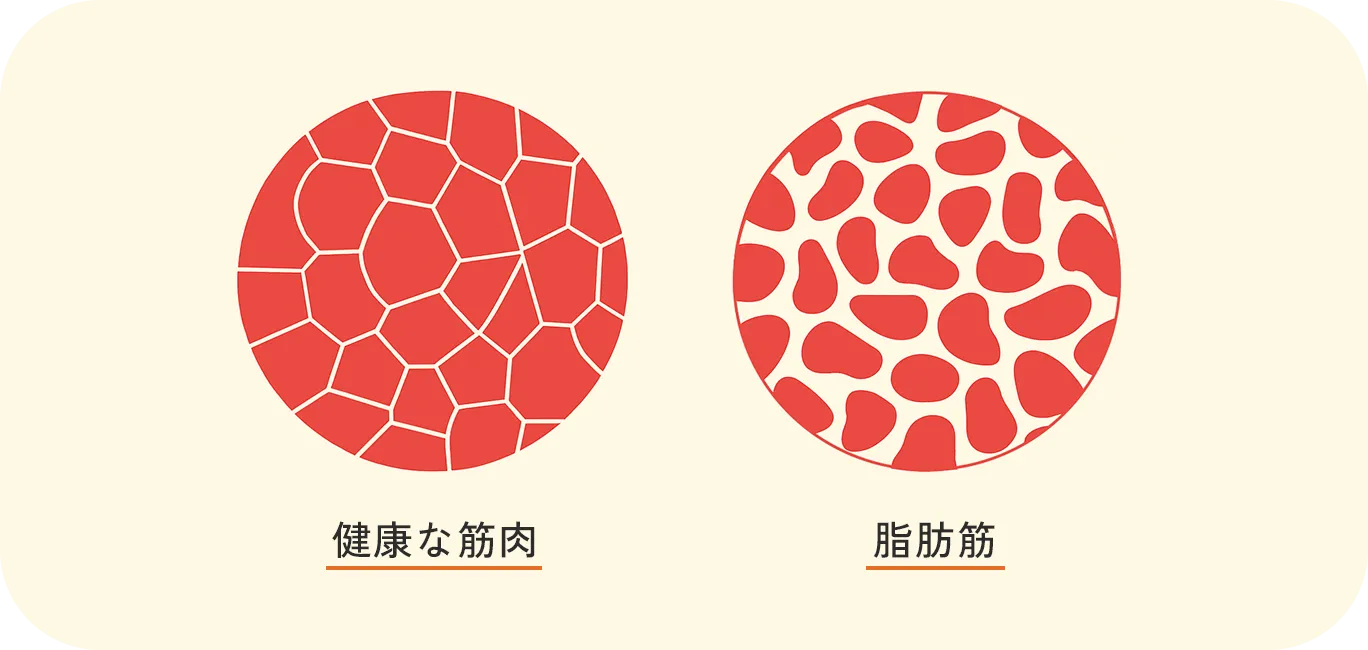 健康な筋肉と脂肪筋の比較図：左側は規則正しい筋繊維構造、右側は筋繊維の間に脂肪が侵入した脂肪筋