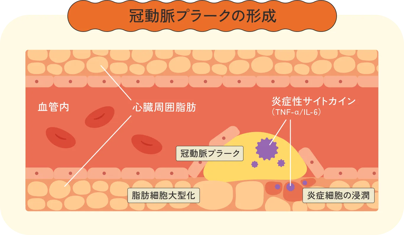 冠動脈プラーク形成のメカニズムを示す医学図解：心臓周囲脂肪から炎症性サイトカインが分泌され、脂肪細胞大型化と炎症細胞浸潤により血管内に冠動脈プラークが形成される過程